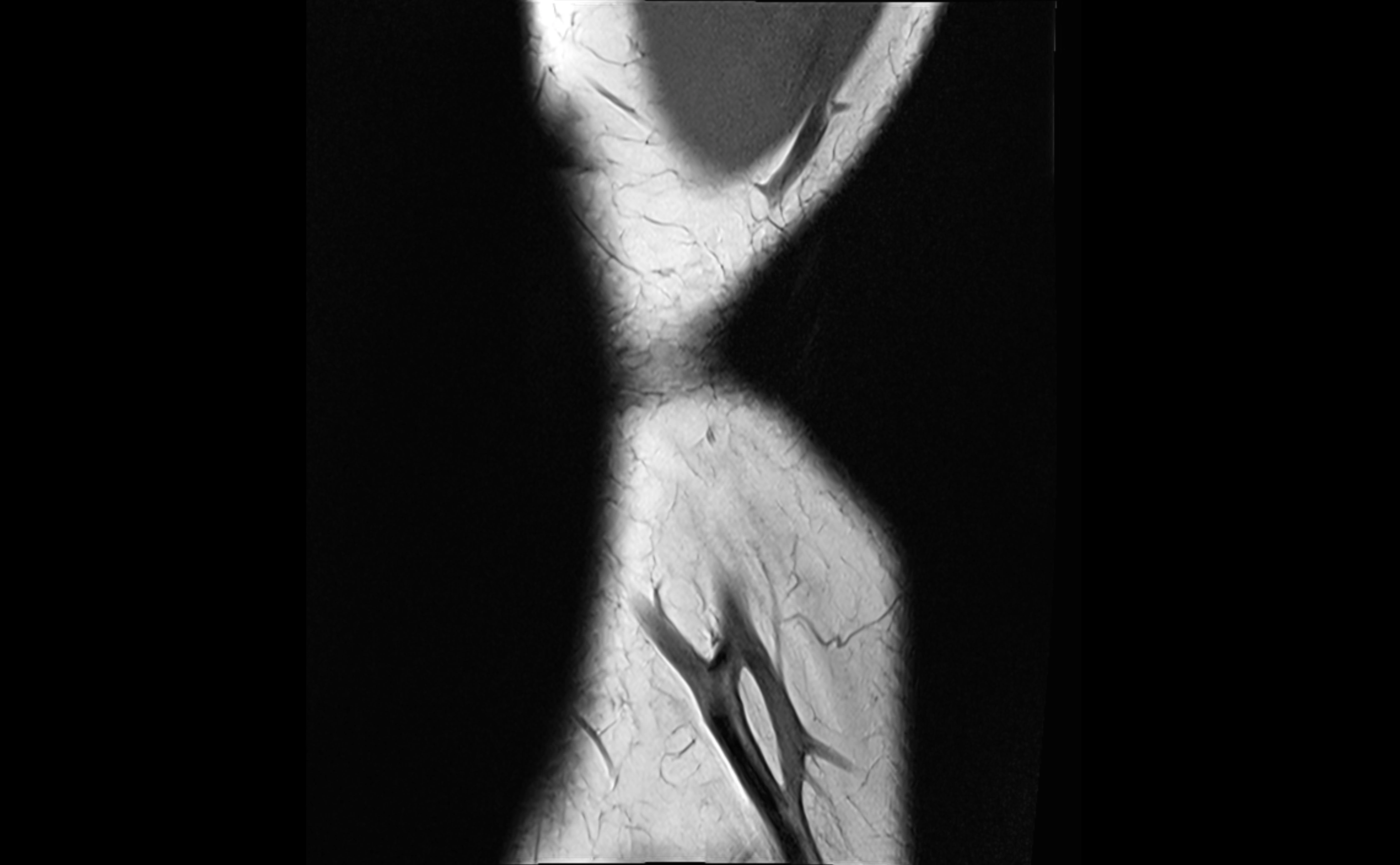 MRI elbow ligaments coronal cross sectional anatomy 3T  radiology  image-img-07001-00003.webp